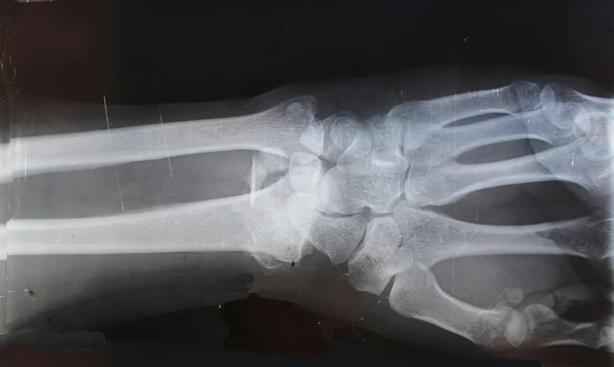 a close up of a broken bone with a broken bone in the middle