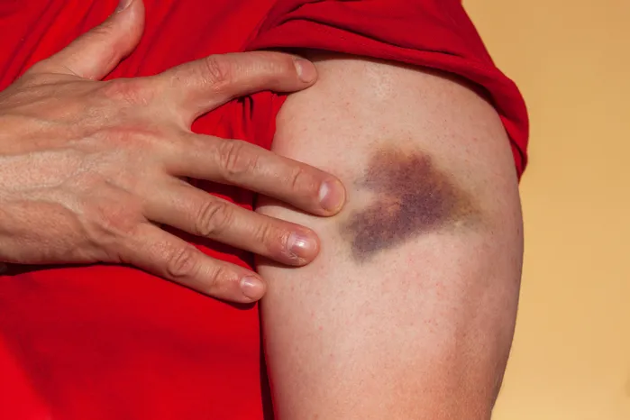 Common Soft Tissue Injuries In Car Accidents Cover Image