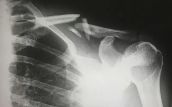 What Is The Average Settlement For A Broken Bone In A Car Accident Cover Image